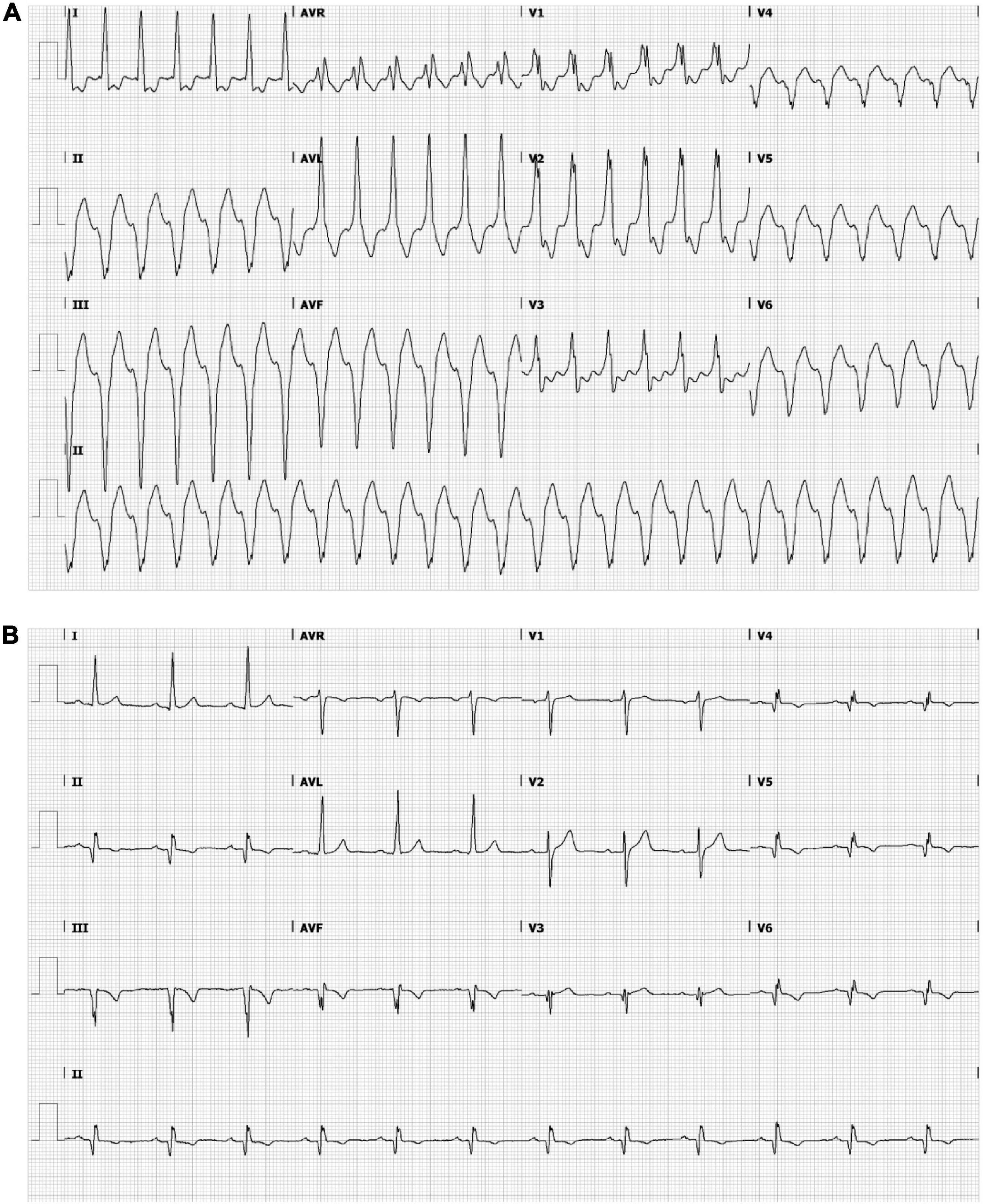 High-resolution structural-functional substrate-trigger characterization: Future roadmap for catheter ablation of ventricular tachycardia